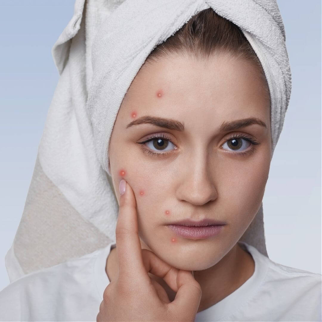 Acne Treatment facial