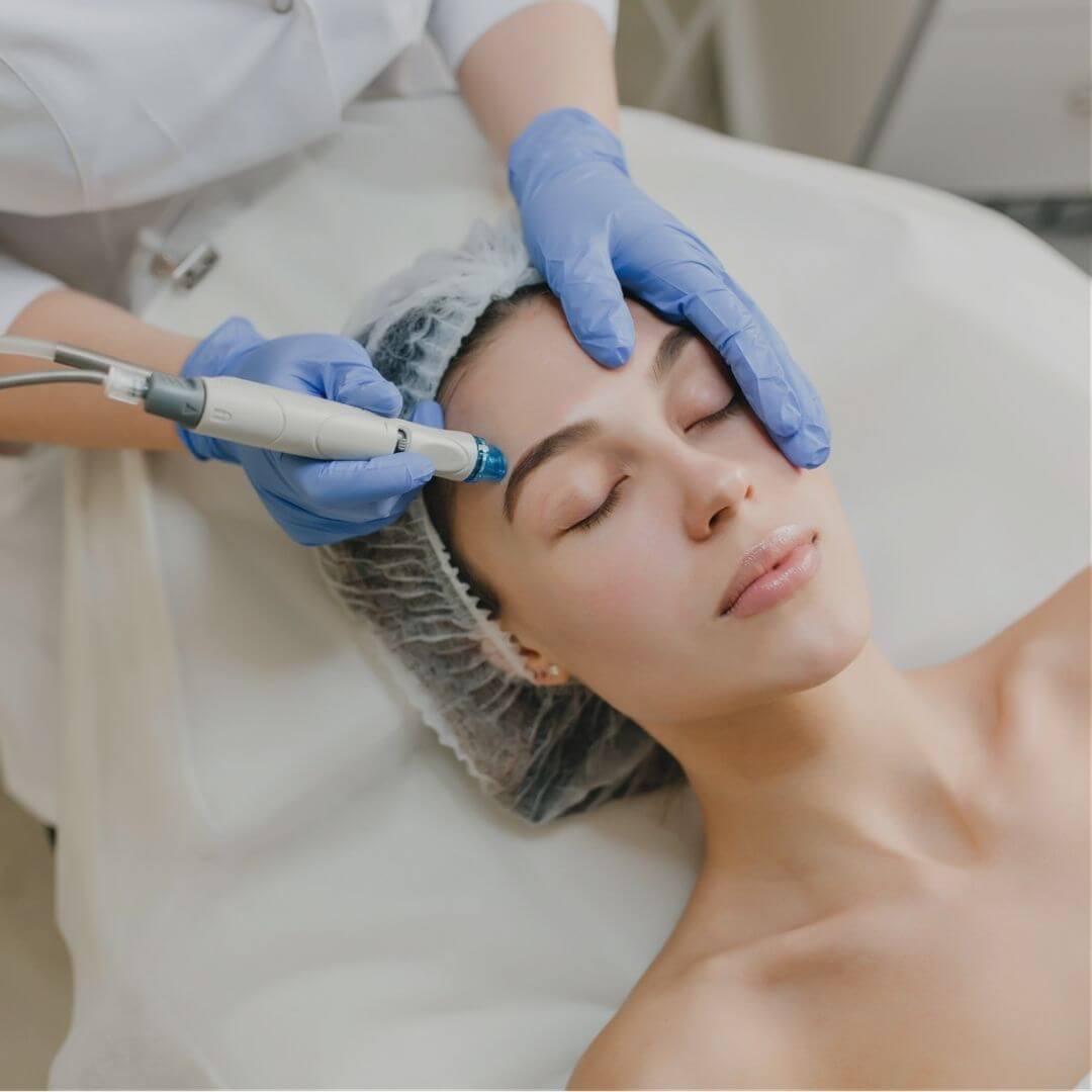 Radio-fractional Skin Needling